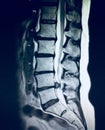 Severe pathology of lumbar spine herniation mri Royalty Free Stock Photo