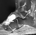 Right foot dorsal aspect mass mri exam