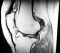 Knee severe osteoarthrosis meniscus pathology mri