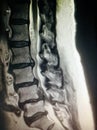 Severe spinal canal stenosis pathology mri exam