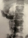 Xray examination abdomen pelvis gunshot war victim