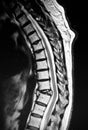 Thoracic vertebrae pathological body compression mri Royalty Free Stock Photo