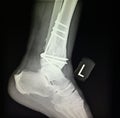 Ankle left tibia distal fracture treatment xray Royalty Free Stock Photo