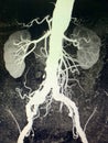 Abdominal aorta aneurysm rc iliac artery aneurysm