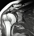 Right humeral surgical neck fracture mri exam