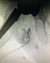 Hip replacement surgery drainage pelvic area