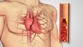 Atherosclerosis disease or Human heart with blocked arteries