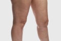 Thick female legs with cellulite and varicose veins. Overweight and disease. Close-up.  on a light gray background Royalty Free Stock Photo