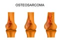 The thigh bone affected by osteosarcoma