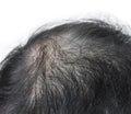 Thinning or sparse hair, male pattern hair loss in Southeast Asian, Chinese elder man