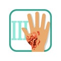 Third degree of burn. Hand with damaged outer epidermis and inner dermis layer of skin. Severe injury. Flat vector Royalty Free Stock Photo