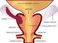 Third stage of prostate cancer. The tumor is big and located in prostate and developed into seminal vesicles