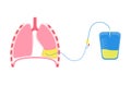 Thoracentesis medical procedure