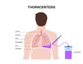 Thoracentesis medical procedure