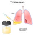 Thoracentesis. Thoracocentesis is an invasive medical procedure