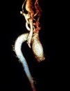 Thoracic aorta aneurism mra