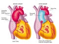 Thoracic aortic aneurysm
