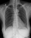 Thoracic Cavity Imaging: How X-Rays Help Diagnose Respiratory Disorders