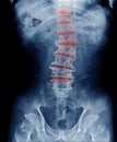 Lumbar spine x-ray image