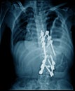 Thoracic spine fixation