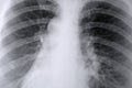 Thorax X-ray of the lungs