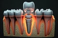 Dental implant with caries. Dental concept