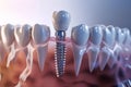 Three-dimensional illustration of peri-implantitis with gingival recession. Medically accurate. Royalty Free Stock Photo