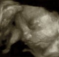 Three-Dimensional sonogram