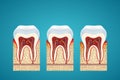 Three human tooth in cutaway with gum disease