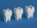 Three stages of tooth decay. 3d illustration