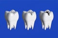 Three teeth in a row, Three stages of tooth decay Royalty Free Stock Photo