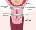 Three types of Cervical cerclage or cervical stitch, treatment for cervical weakness. Transabdominal, Shirodkar and McDonald