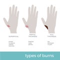 Three types of skin burns