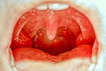 Throat tonsil