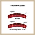 Thrombocytosis. Elevated levels of blood platelets. Infographics. Vector illustration