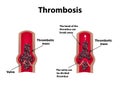 Thrombocytosis. Embolism. Infographics. Vector illustration on isolated background Royalty Free Stock Photo