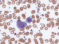 Thrombocytosis, myeloblast and giant platelet. Royalty Free Stock Photo