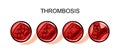 Thromboembolism artery. blockage