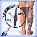 Thrombophlebitis, blood clots in the veins. Embolism. Thrombosis