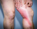 Thrombophlebitis in human leg Royalty Free Stock Photo