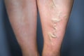 Thrombophlebitis in human leg