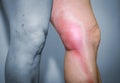 Thrombophlebitis in human leg Royalty Free Stock Photo