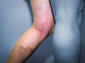 Thrombophlebitis in human leg Royalty Free Stock Photo