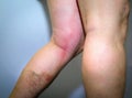 Thrombophlebitis in human leg Royalty Free Stock Photo