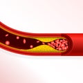 Thrombosis of artery - cholesterol buildup, arteriosclerosis Royalty Free Stock Photo