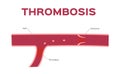 Thrombosis in blood vein / organ and anatomy concept / Pulmonary Embolism