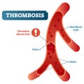 Thrombosis medical vector illustration cross section diagram,unhealthy blood vessel circulatory system disease.Blocked blood flow. Royalty Free Stock Photo