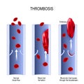 Thrombosis. embolism Royalty Free Stock Photo