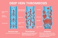 Thrombosis. From Normal blood flow to Blood clot formation
