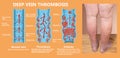 Thrombosis. From Normal blood flow to Blood clot formation